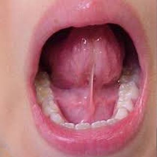 frenulum ling